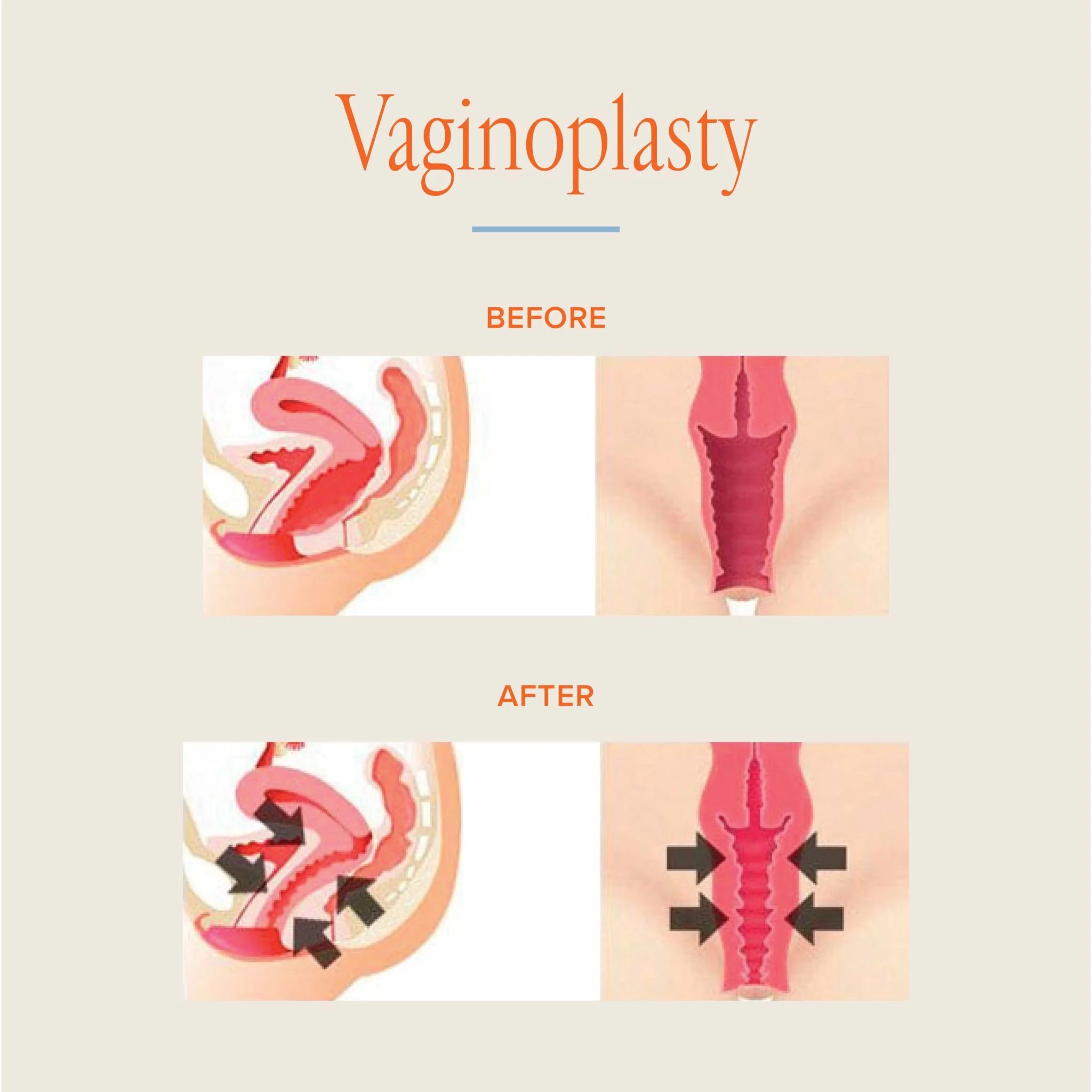 Vaginoplasty NYC- Vaginal Rejuvenation NYC