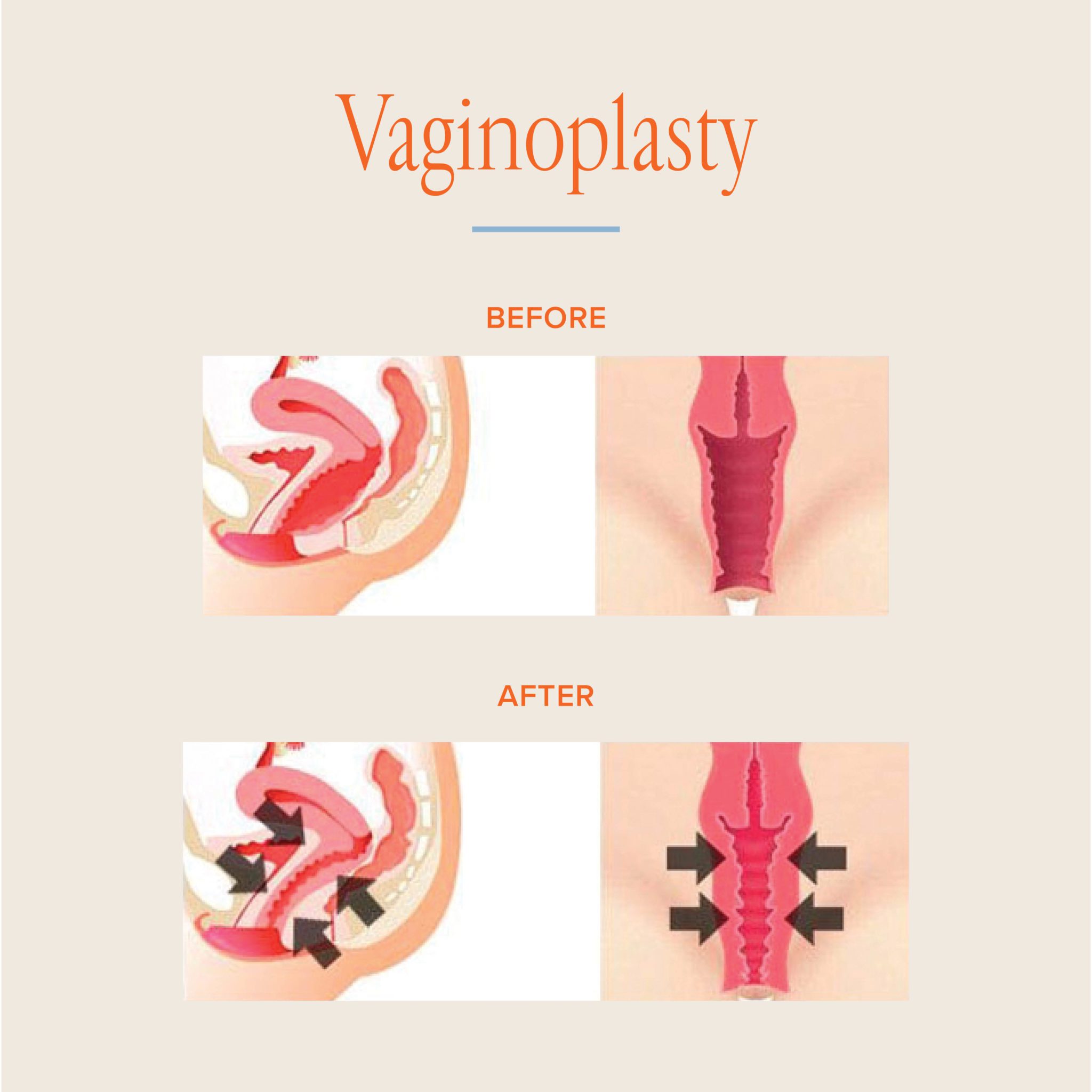 Vaginal Reconstruction Feminine Rejuvenation Rejuveyourbody