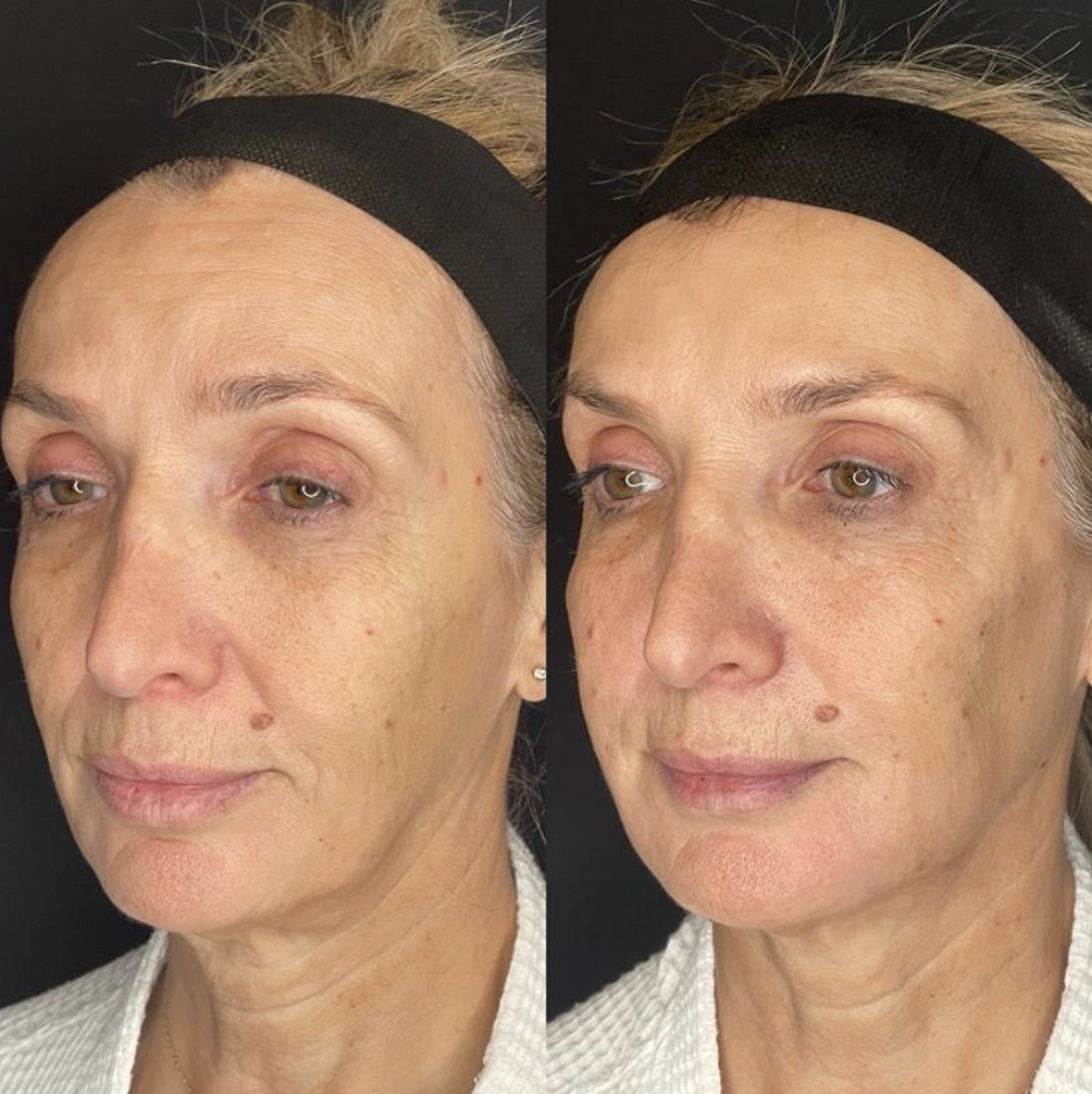 Before and After Cosmetic Dermatology