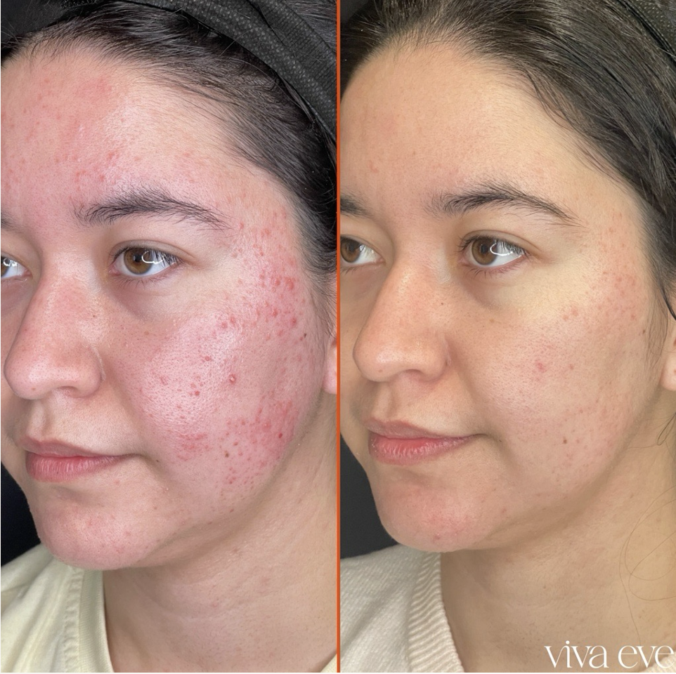 Before and After Cosmetic Dermatology