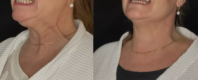 Bernadette Nefertiti Neck Treatment