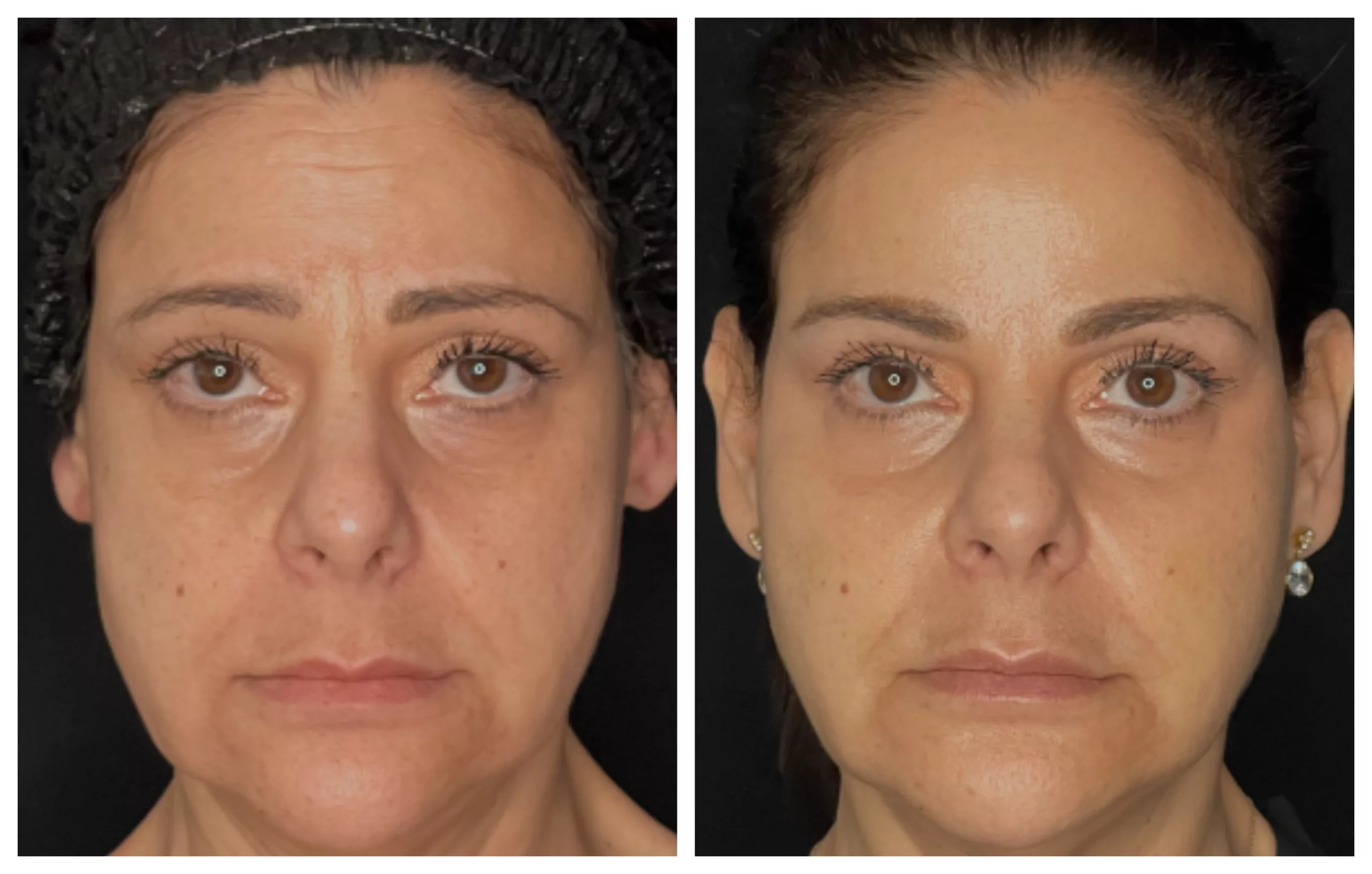 Botox Before & After Photos, Patient Photo, Pictures