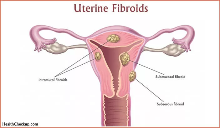 Adenomyosis: Could it be the suspect of heavy, painful periods?