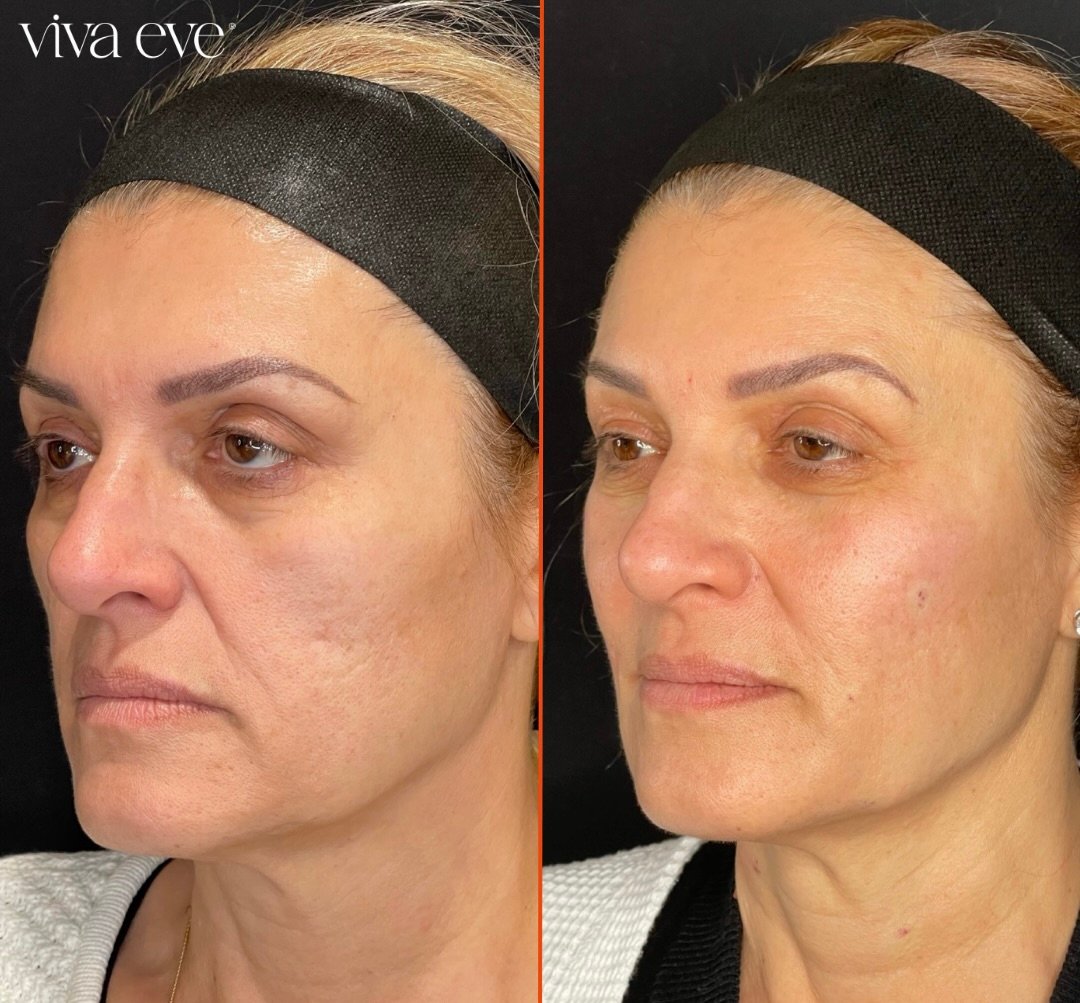 Biostimulators & Sculptra®