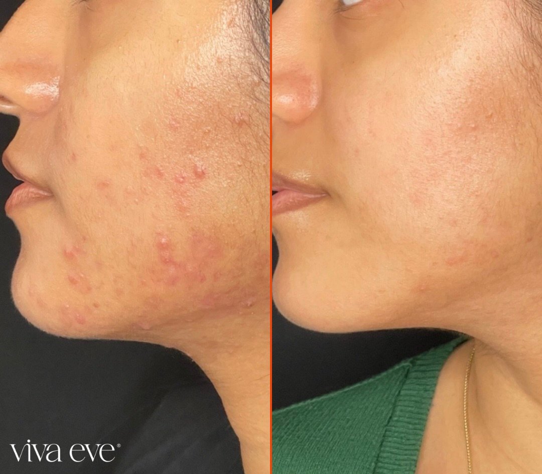 Acne Treatment