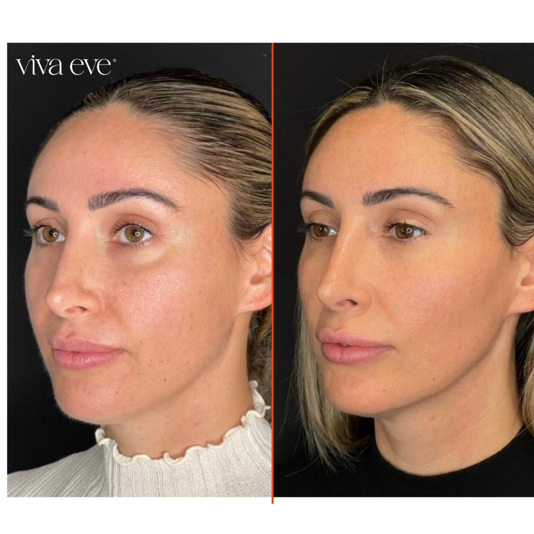 Full Facial Balancing