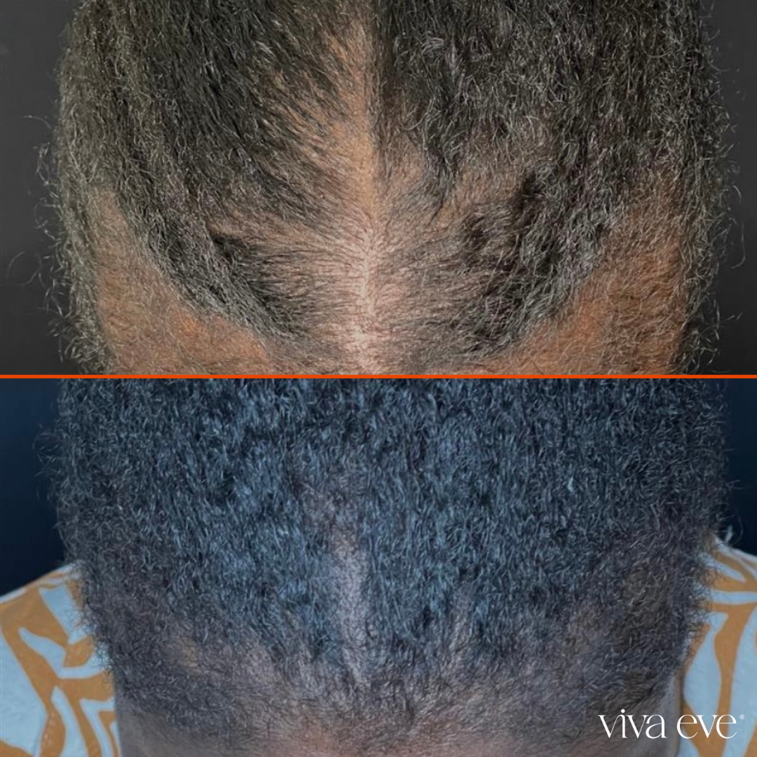 Hair Restoration