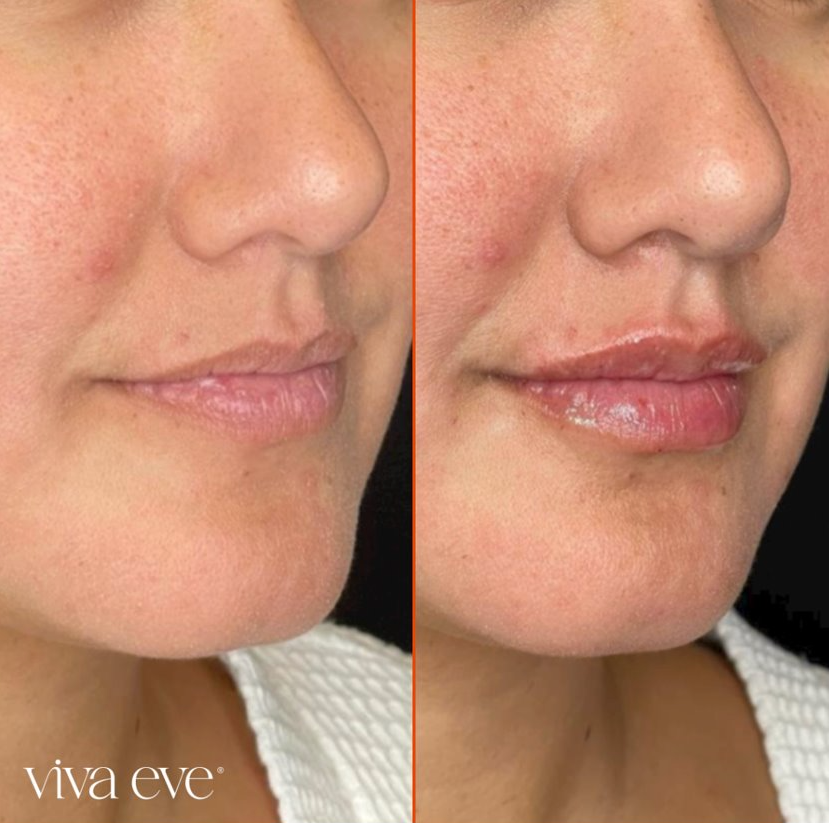 Lip Filler & Rejuvenation