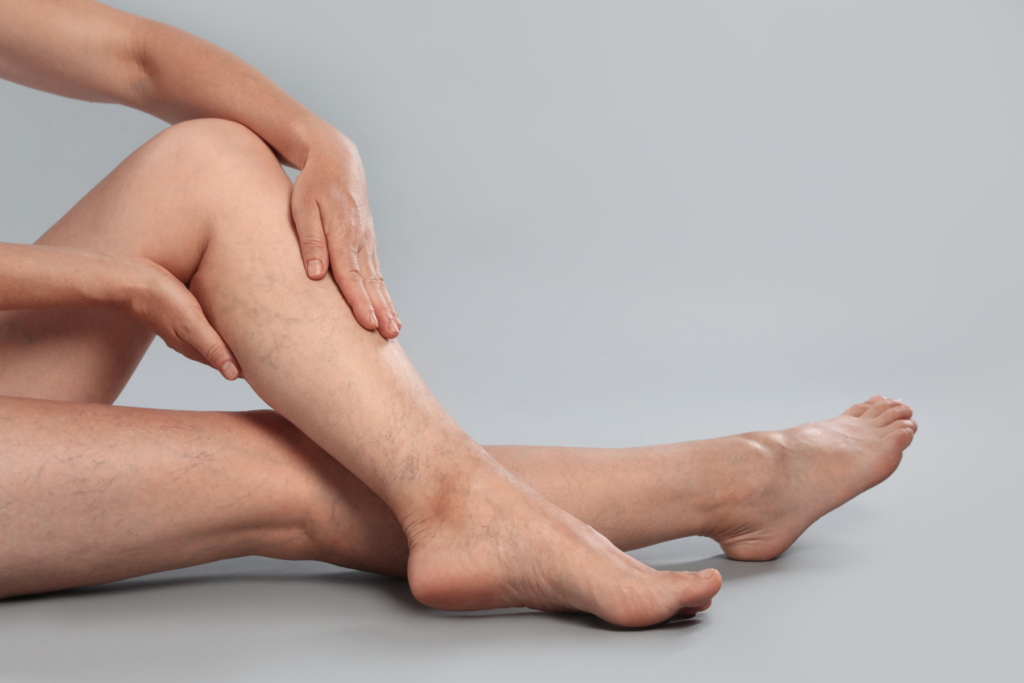 Woman touching visible veins on her leg, illustrating prominent leg veins that may become more noticeable in summer.